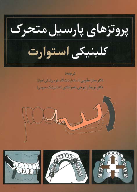 پروتزهای پارسیل متحرک کلینیکی استوارت