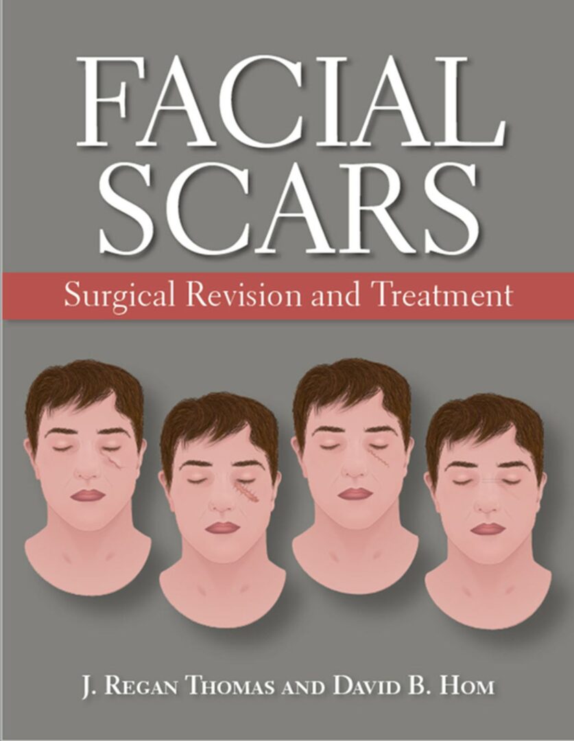 Facial Scars : Surgical Revision and Treatment - 2019