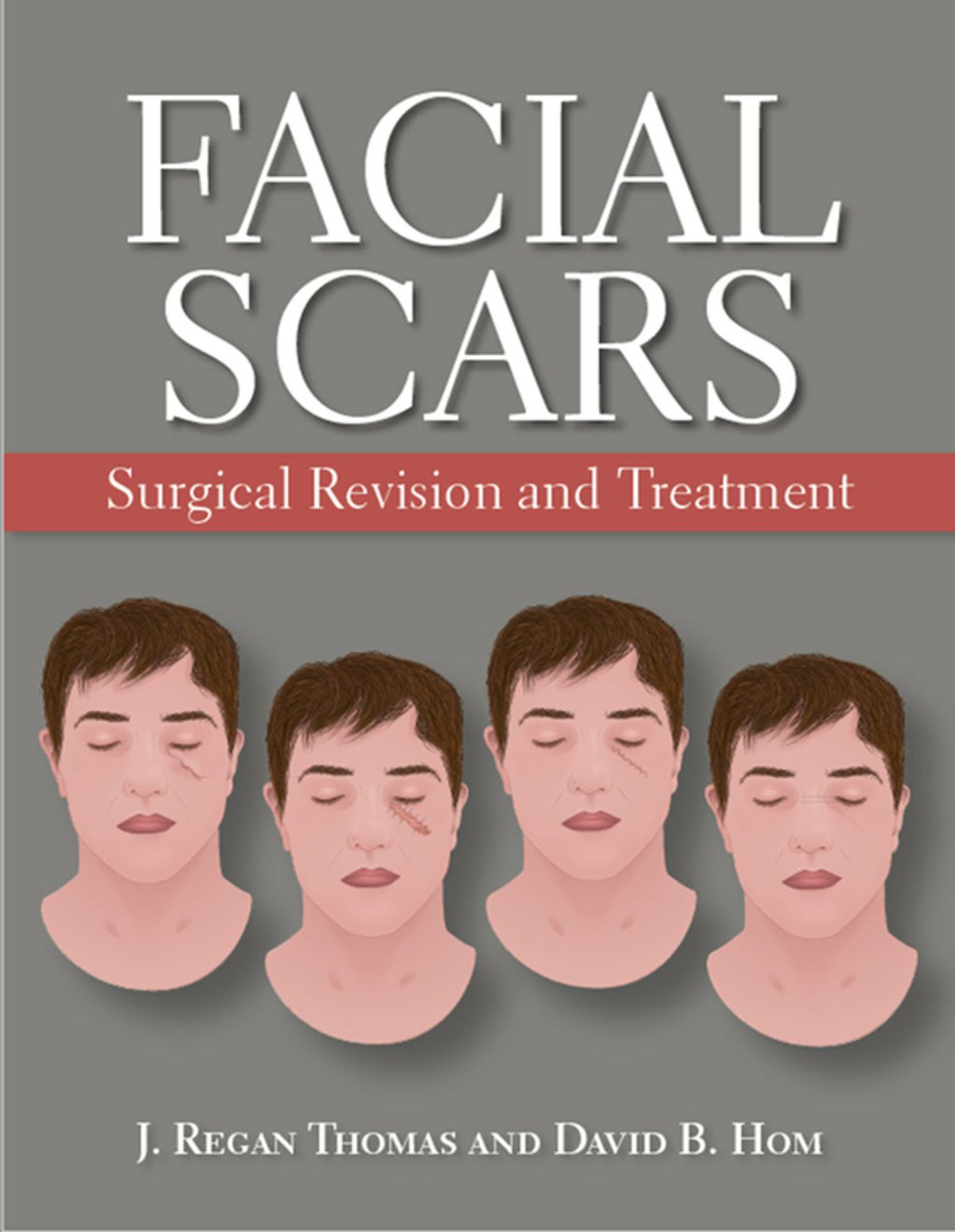 Facial Scars : Surgical Revision and Treatment - 2019