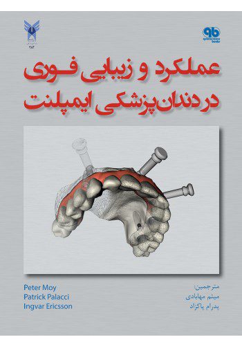 عملکرد و زیبایی فوری در دندانپزشکی ایمپلنت