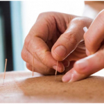 آنچه باید در مورد طب سوزنی بدانید !