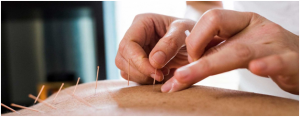 آنچه باید در مورد طب سوزنی بدانید !