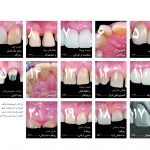 دندانپزشکی زیبایی - کتاب لمینت و ونیر