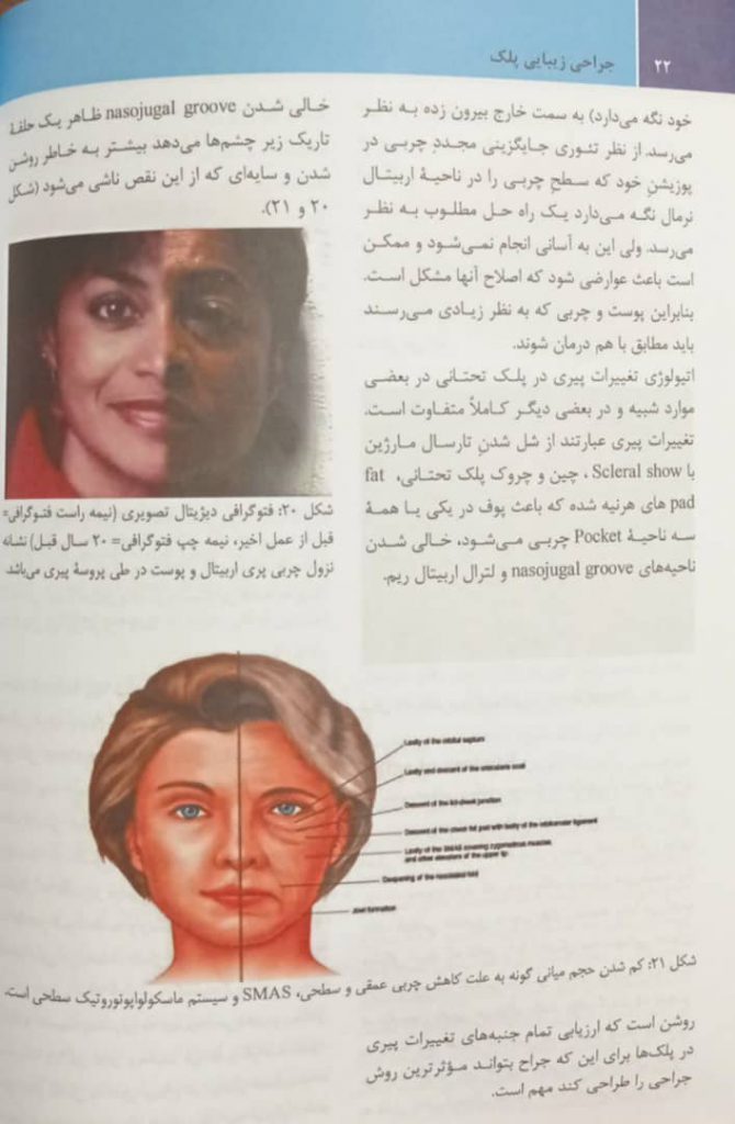 نمونه داخل کتاب جراحی زیبایی پلک | تالیف دکتر ترجمی