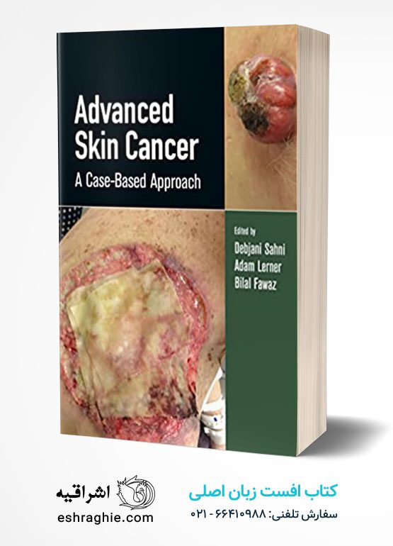 Advanced Skin Cancer: A Case-Based Approach