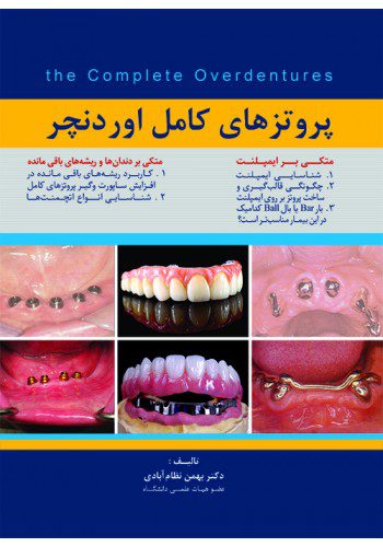 پروتزهای کامل اوردنچر