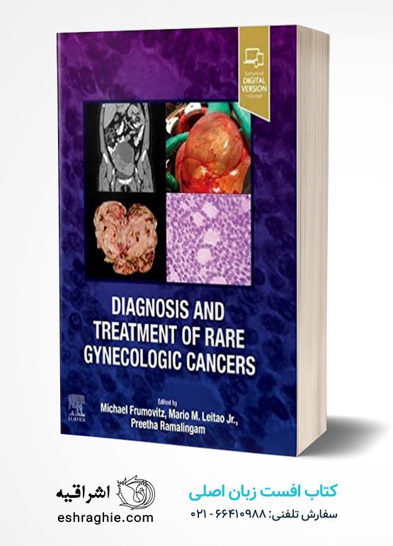 Diagnosis and Treatment of Rare Gynecologic Cancers