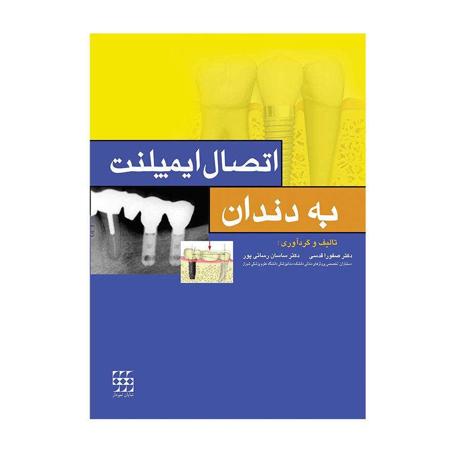اتصال ایمپلنت به دندان