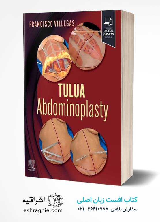TULUA Abdominoplasty: Transverse Plication Technique 1st Edition